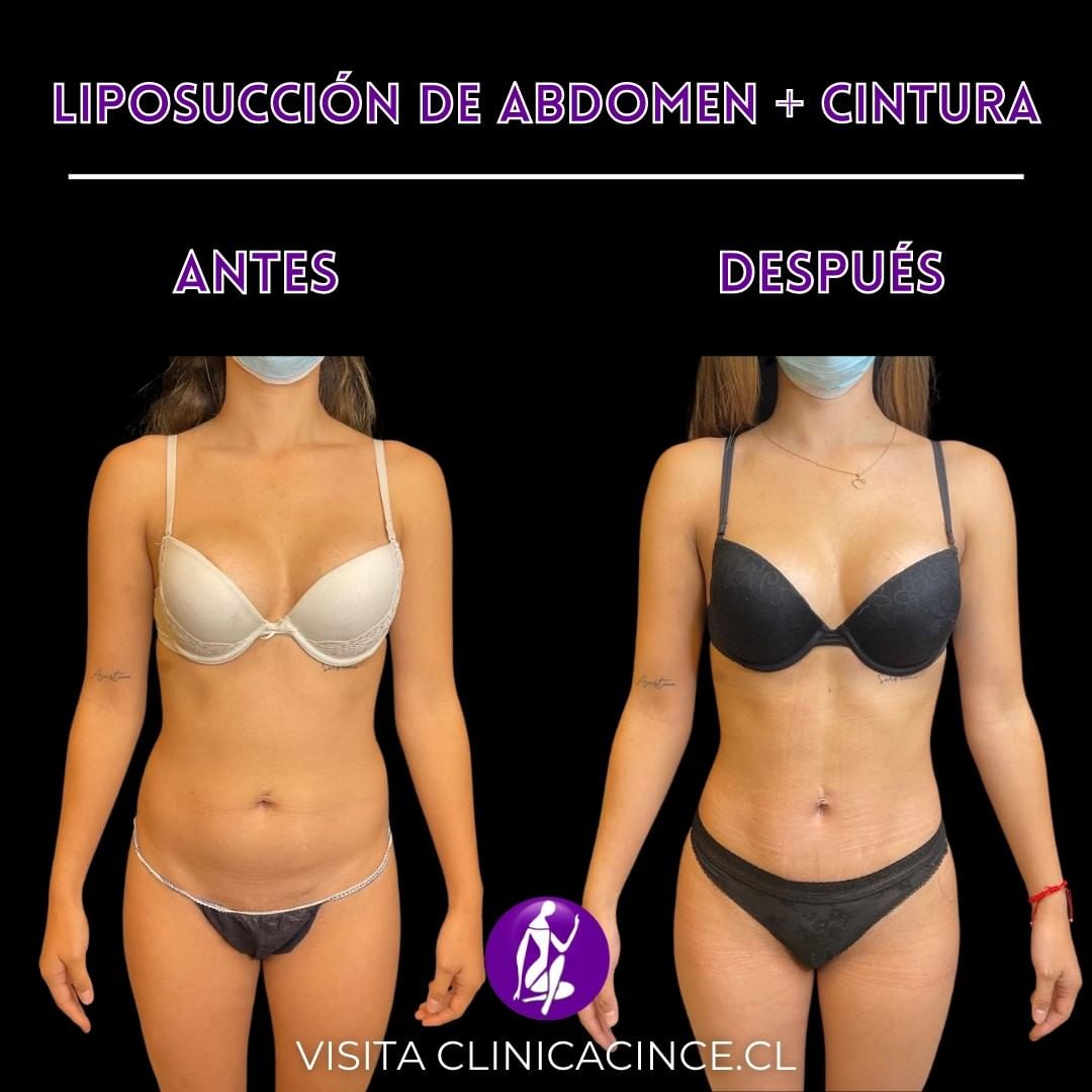 Lipoescultura De Abdomen Flancos Cl Nica Cince